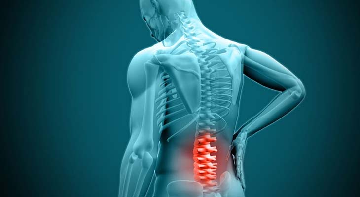 Herniated Disc