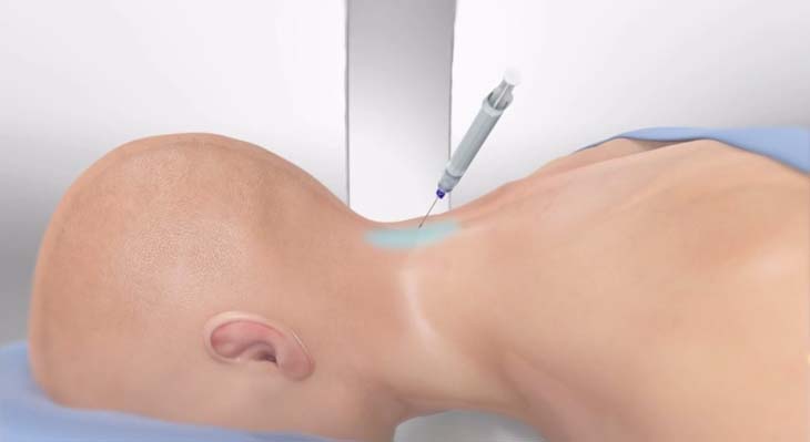 Spine Injection